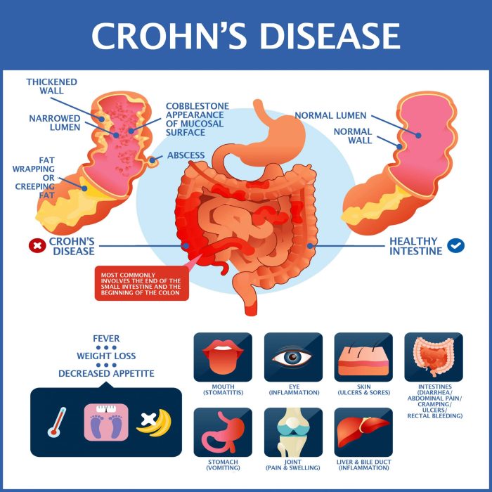 Been Diagnosed With Crohn’s Disease? | Gastroenterology of Greater Orlando