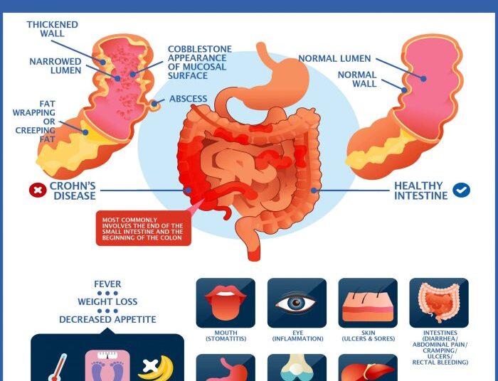 Crohn's Disease IBD Symptoms Advances Impact Causes