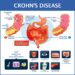 Crohn's Disease IBD Symptoms Advances Impact Causes